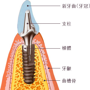 人工植牙構造圖